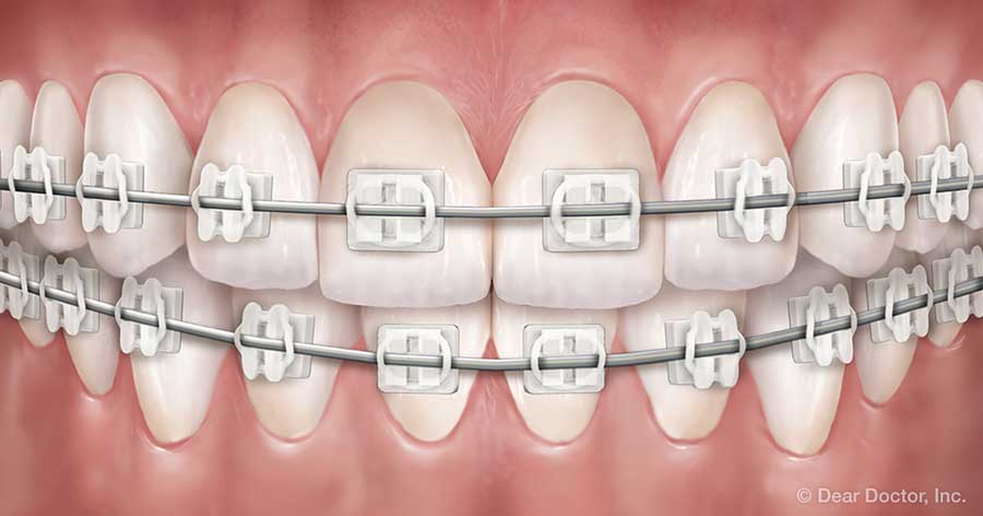 Diagram of clear braces