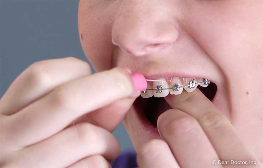 Person flossing between braces