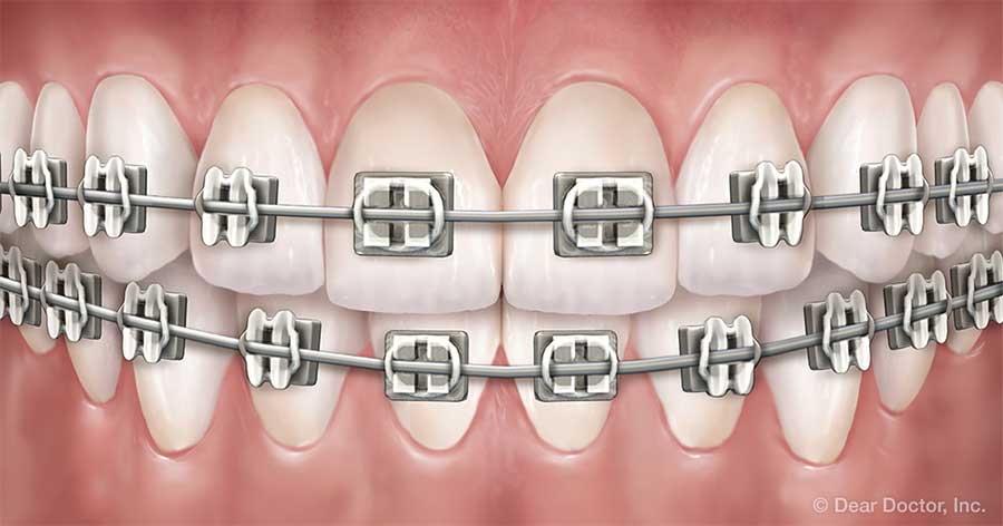 Traditional Metal Braces